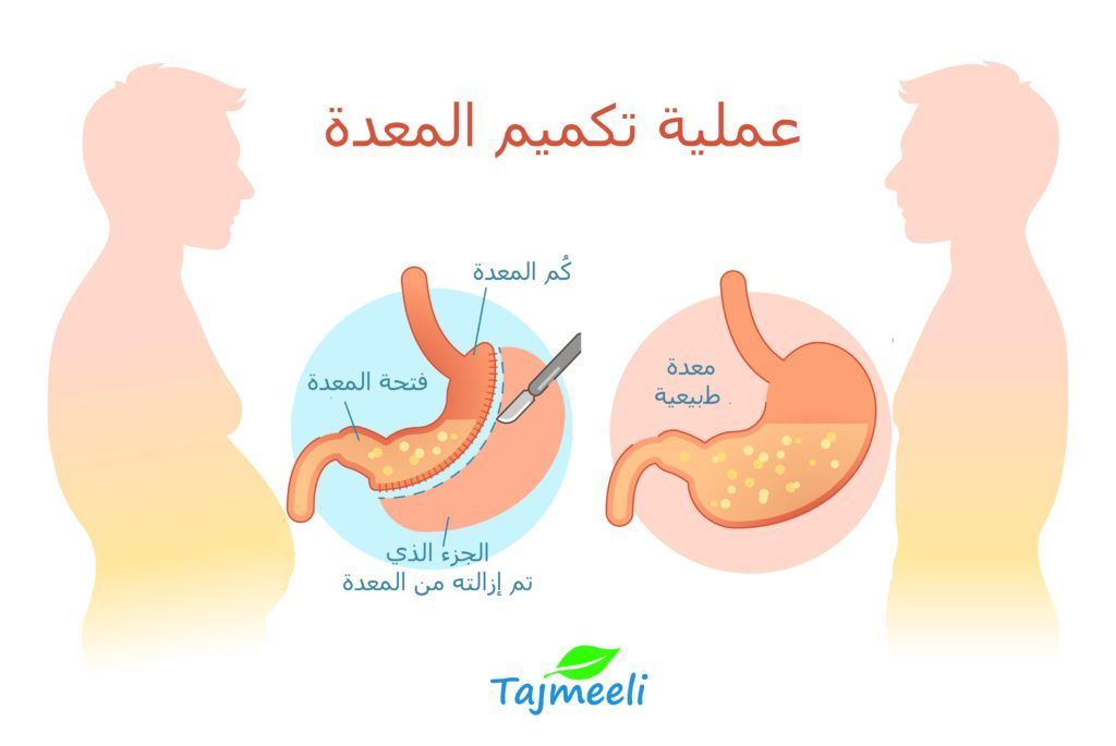 كيف تُجرى عملية تكميم المعدة؟