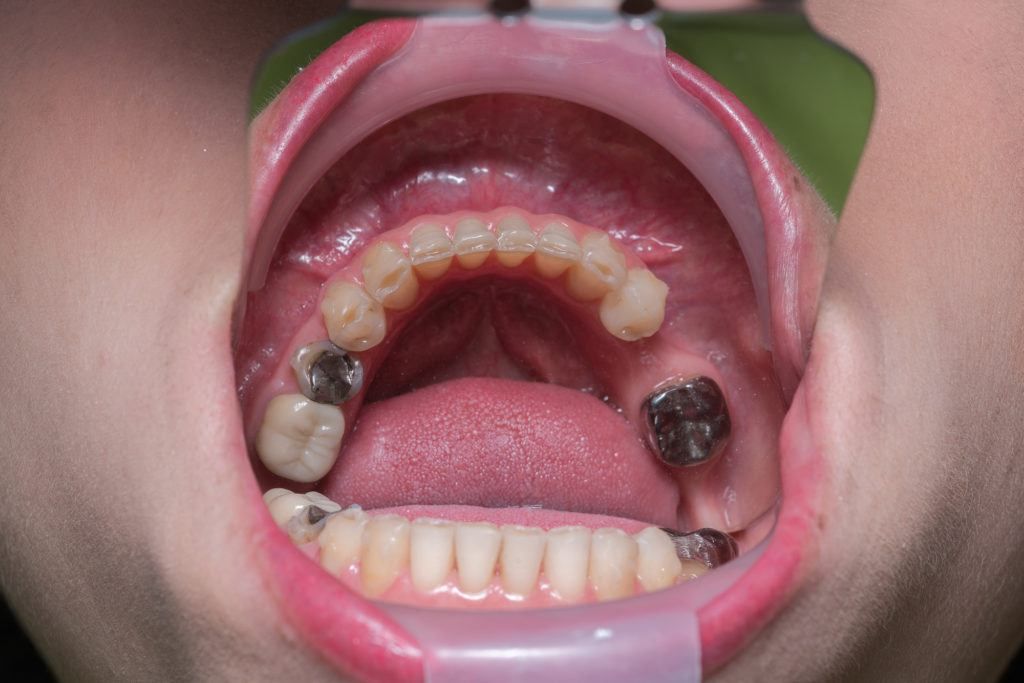 الأشخاص المرشحون لتركيب الاسنان