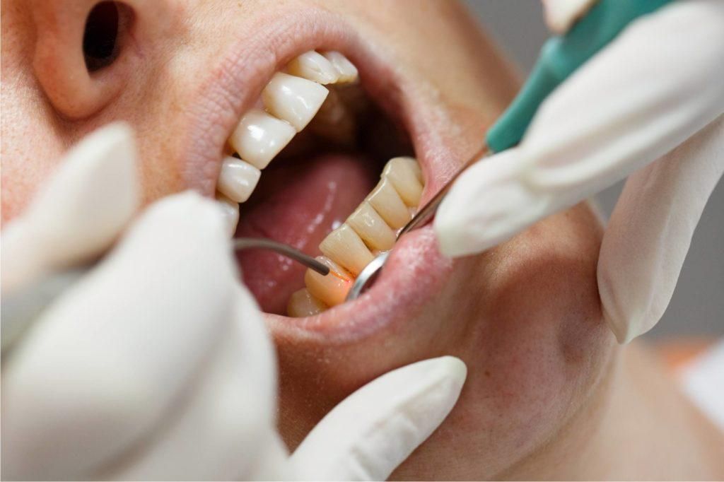 تعديل الاسنان بالليزر