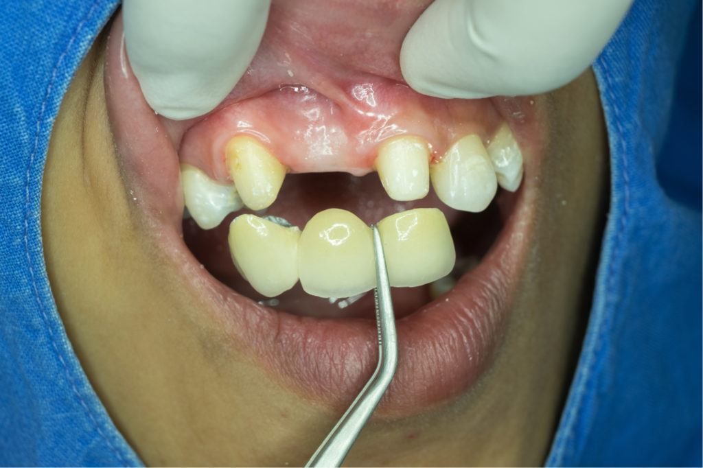 فوائد واستخدامات جسر الاسنان 