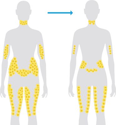 مناطق الجسم التي يعالجها جهاز حرق الدهون فيزر ليبو