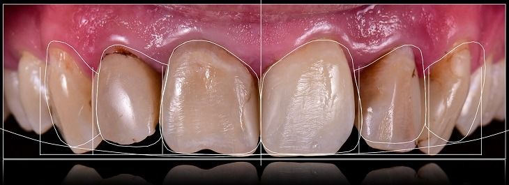 برد الاسنان تصغير وتقويم الاسنان والعيادات تجميلي