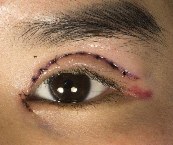 كيفية علاج انتفاخ العين جراحياً 