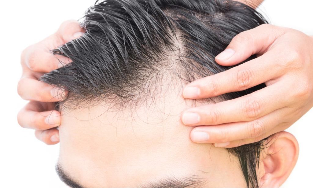 المرشحون لإجراء زراعة الشعر الطبيعي والصناعي 