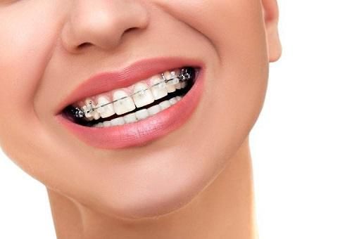 انواع تقويم الاسنان المميزات والعيوب وأكثر تجميلي