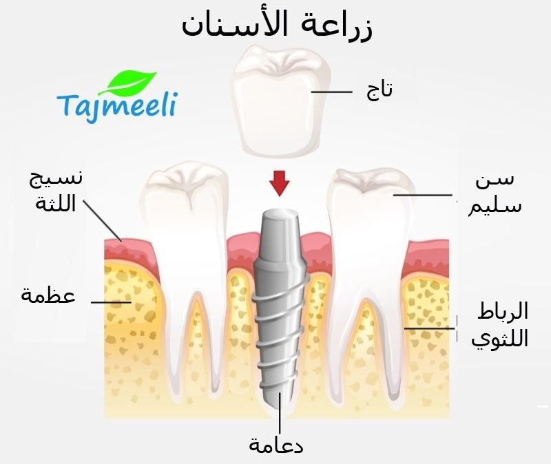 طريقة زراعة الاسنان بدون جراحة