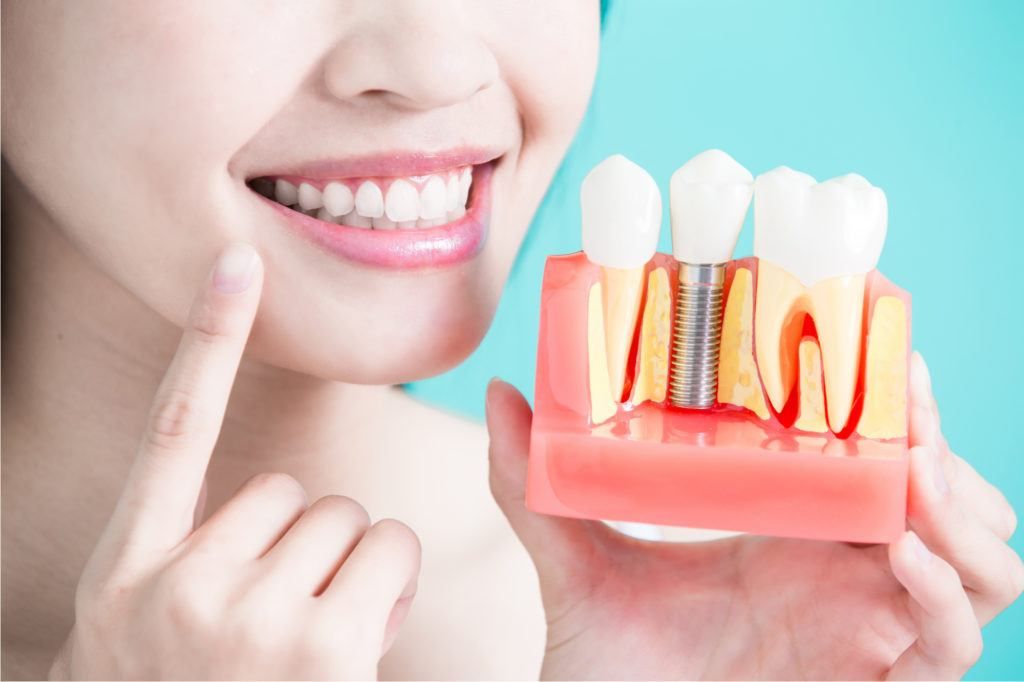 عملية زراعة الأسنان بدون جراحة