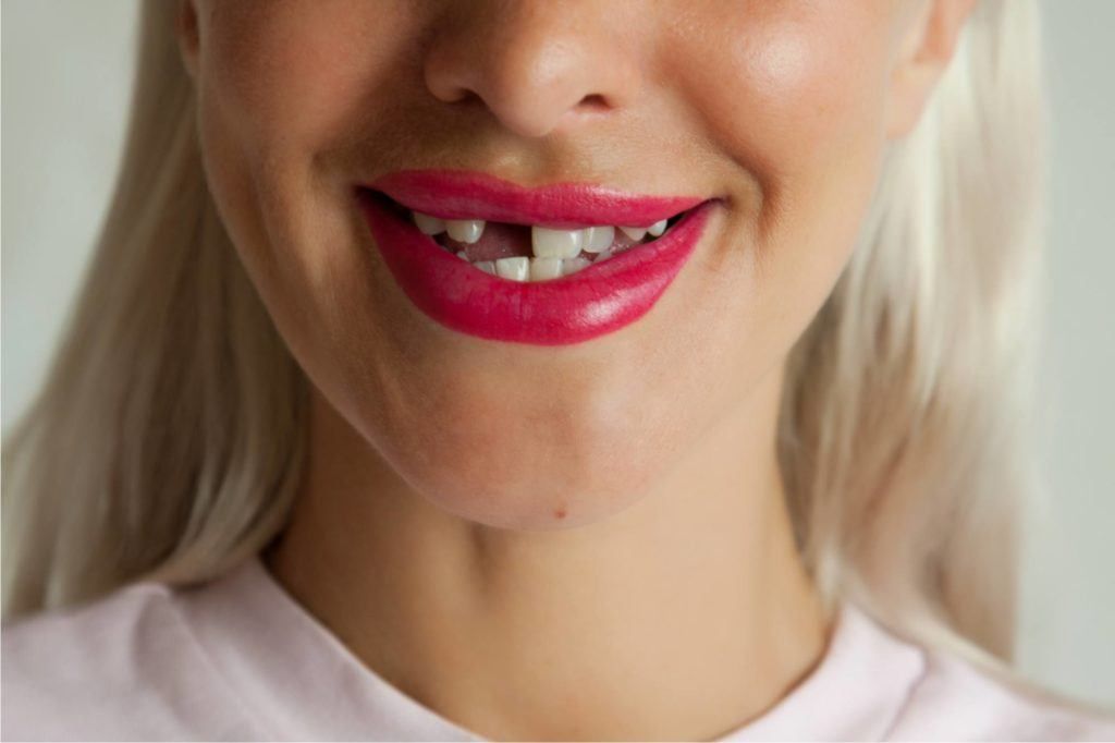 ما هي طريقة ترميم الاسنان الامامية ؟
