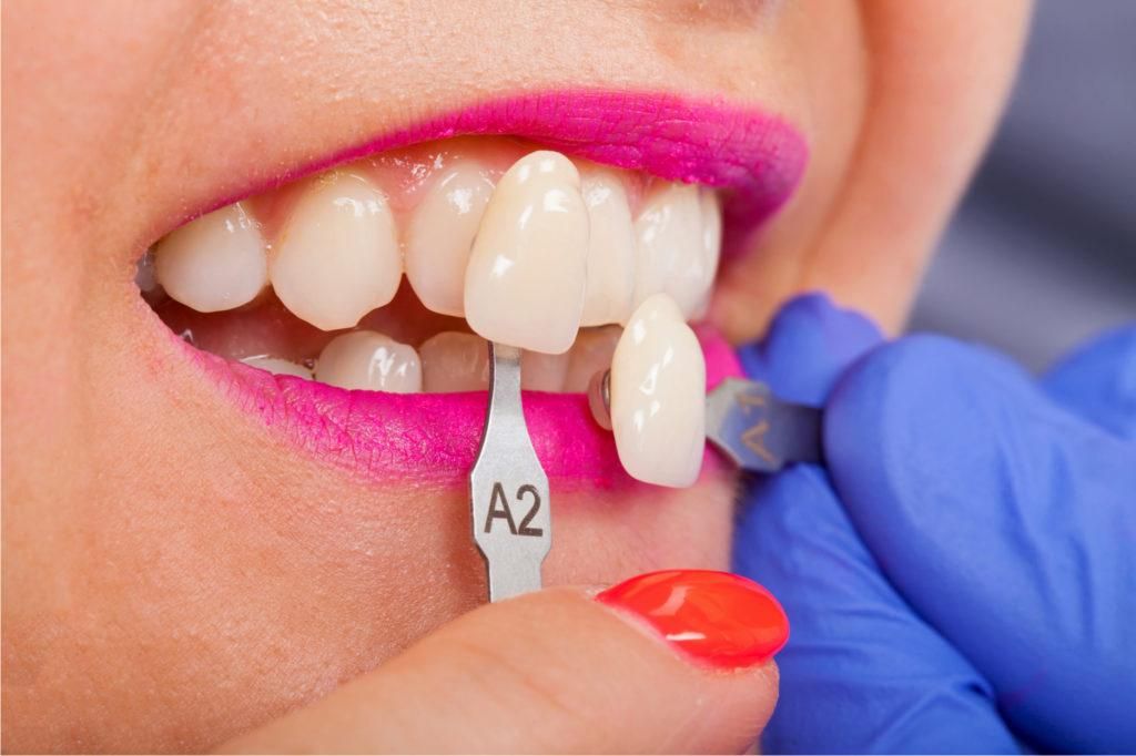 مميزات وعيوب ترميم الاسنان الامامية