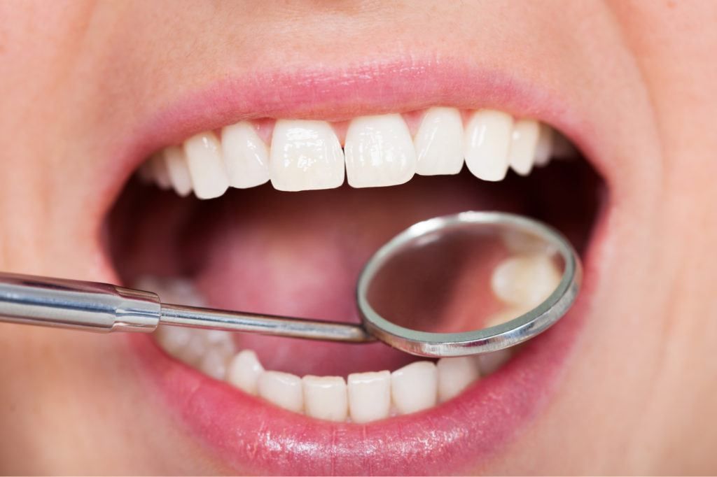 نتائج عملية ترميم الاسنان الامامية