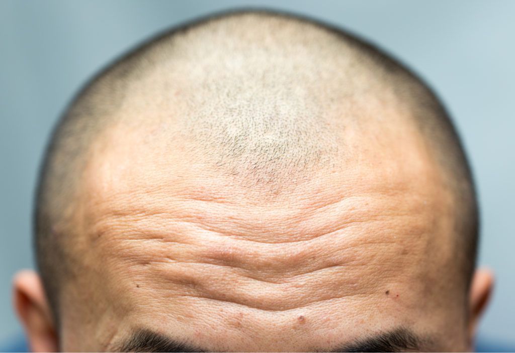 هل انتفاخ الوجه بعد زراعة الشعر يعني فشل العملية؟ 