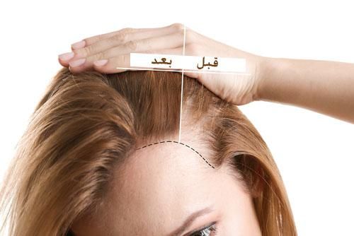 زراعة الشعر لعلاج الصلع عند النساء