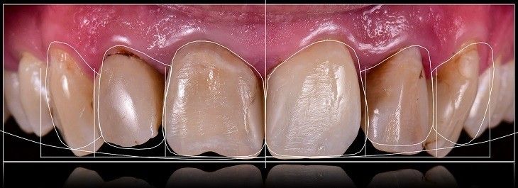 ما هي خطوات عملية نحت الاسنان؟