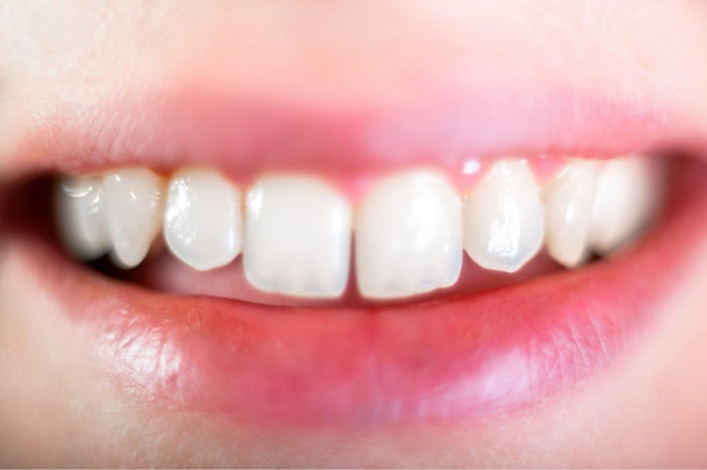 ما هي مميزات عملية نحت الأسنان ؟