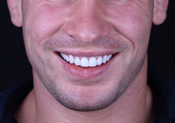 مميزات الاسنان البورسلين