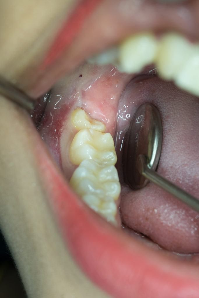 جراحة الاسنان المطموره