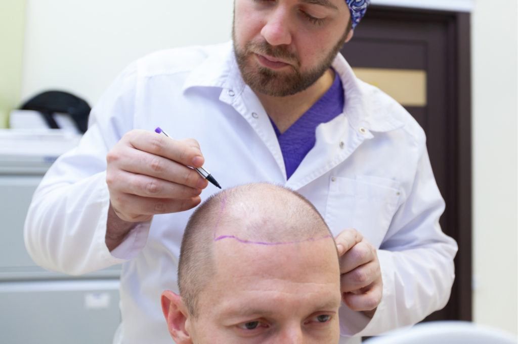 كيفية اختيار الجراح أو المركز المناسب لعملية زراعة الشعر بتقنية السفير