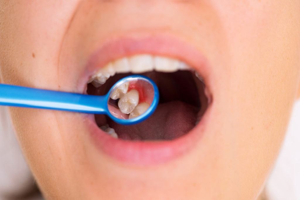 كيفية الاستعداد لعملية الاسنان المطمورة؟