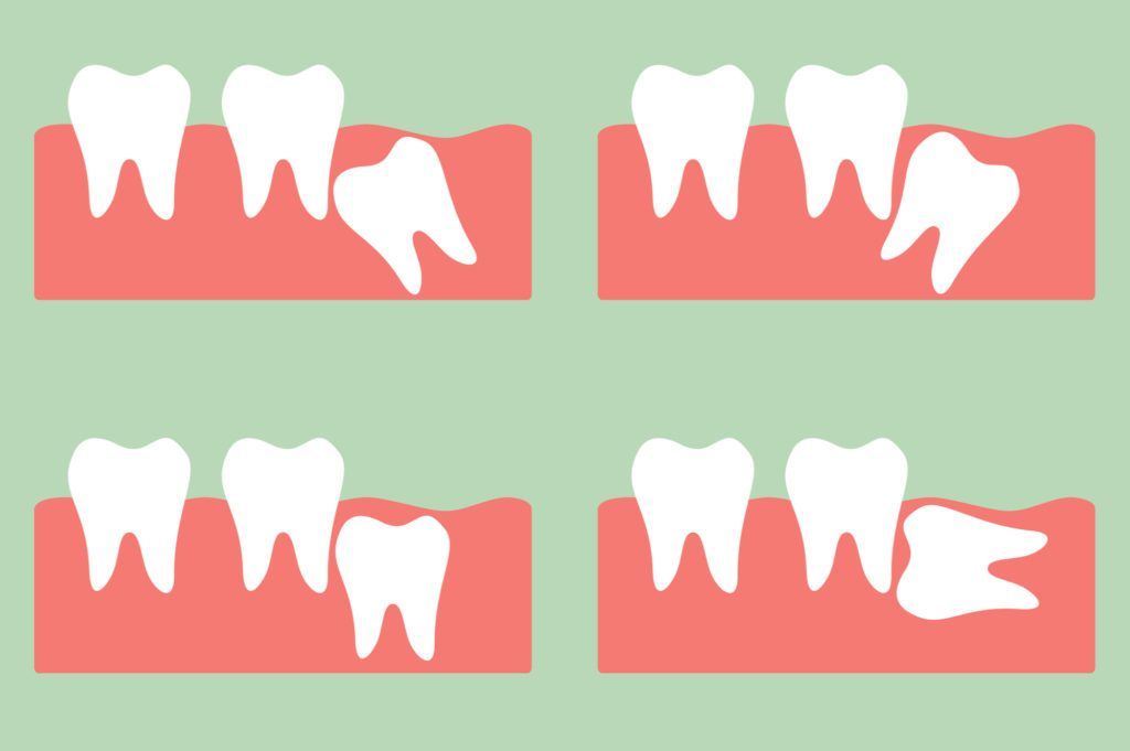 ما هي خطوات جراحة الاسنان المطموره؟