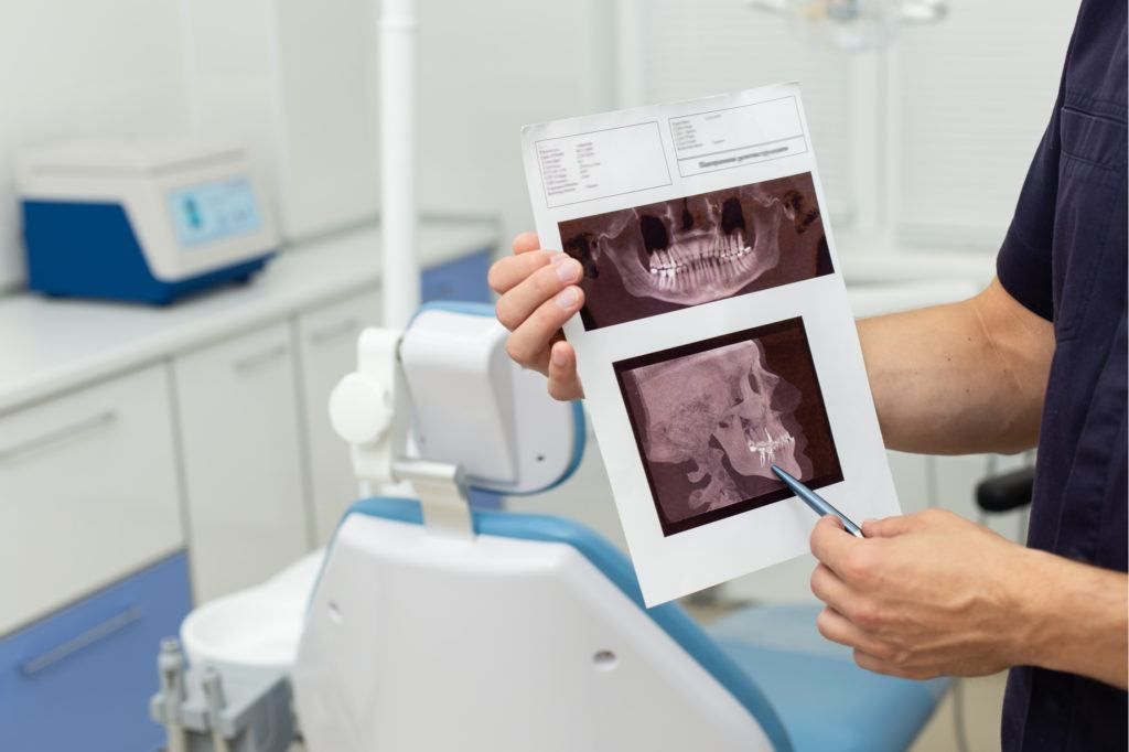 ما هي عملية الاسنان المطمورة؟