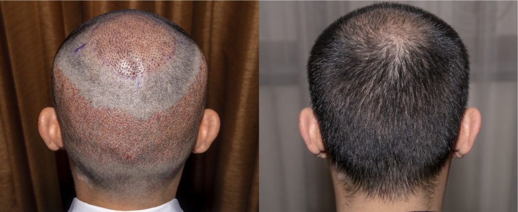  نتائج عملية زراعة الشعر الاسبوع الثالث