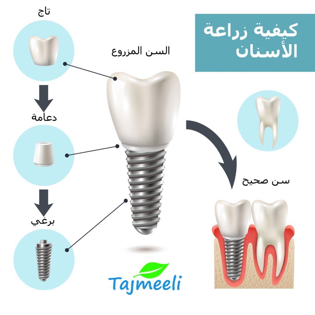 كيف تتم عملية زراعة الأسنان