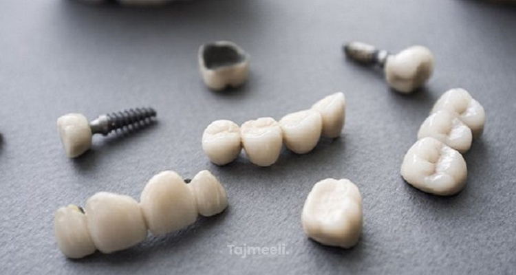 ما هي مراحل زراعة الأسنان ؟ | النتائج والتكلفة | تجميلي