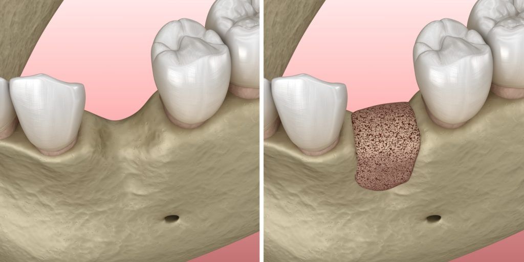 أنواع التطعيمات العظمية المستخدمة في زراعة عظام الاسنان
