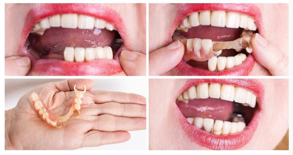 تركيبات الاسنان الاصطناعية المتحركة
