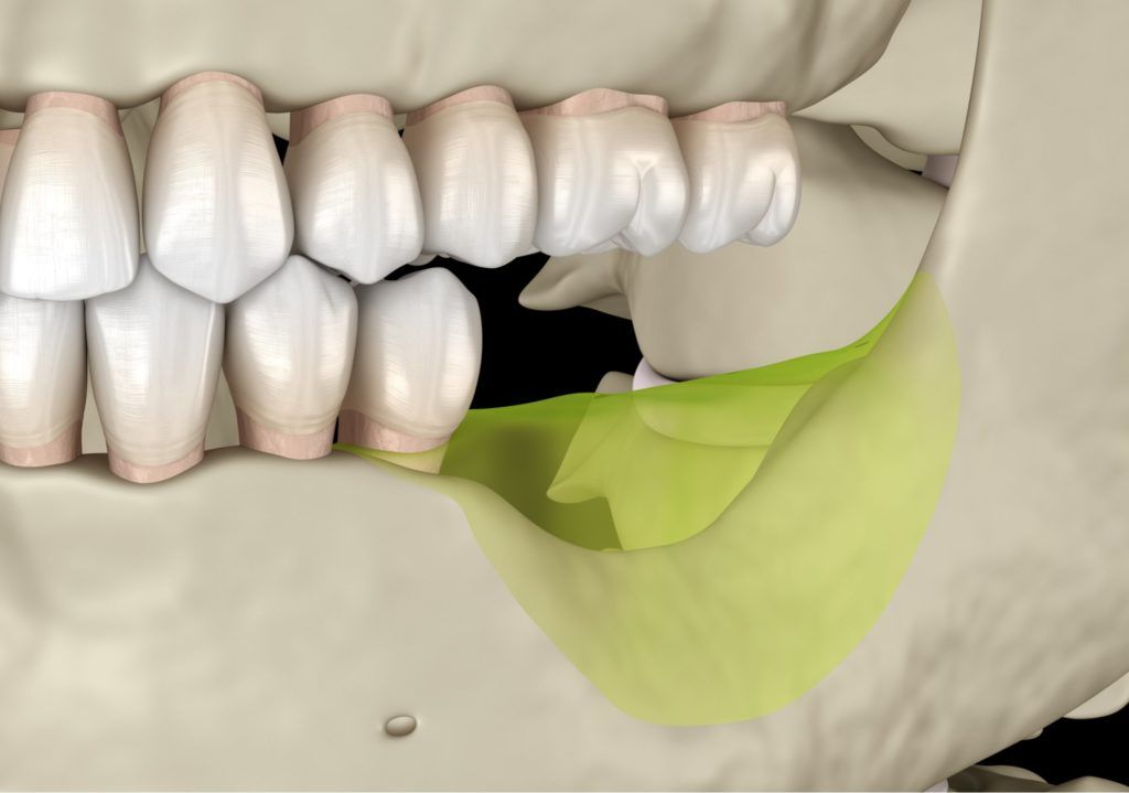 طريقة زراعة عظام الاسنان