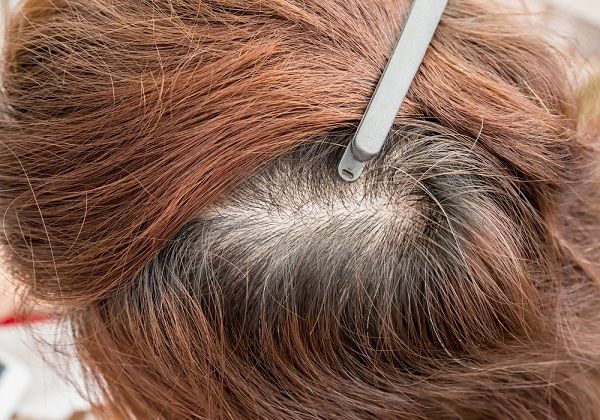 ما هي أشهر أسباب تساقط الشعر
