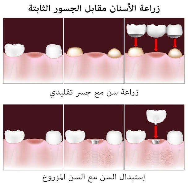 مراحل تطور زراعة الأسنان