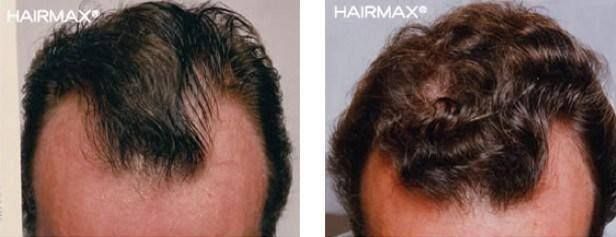 مميزات جهاز هير ماكس لنمو الشعر