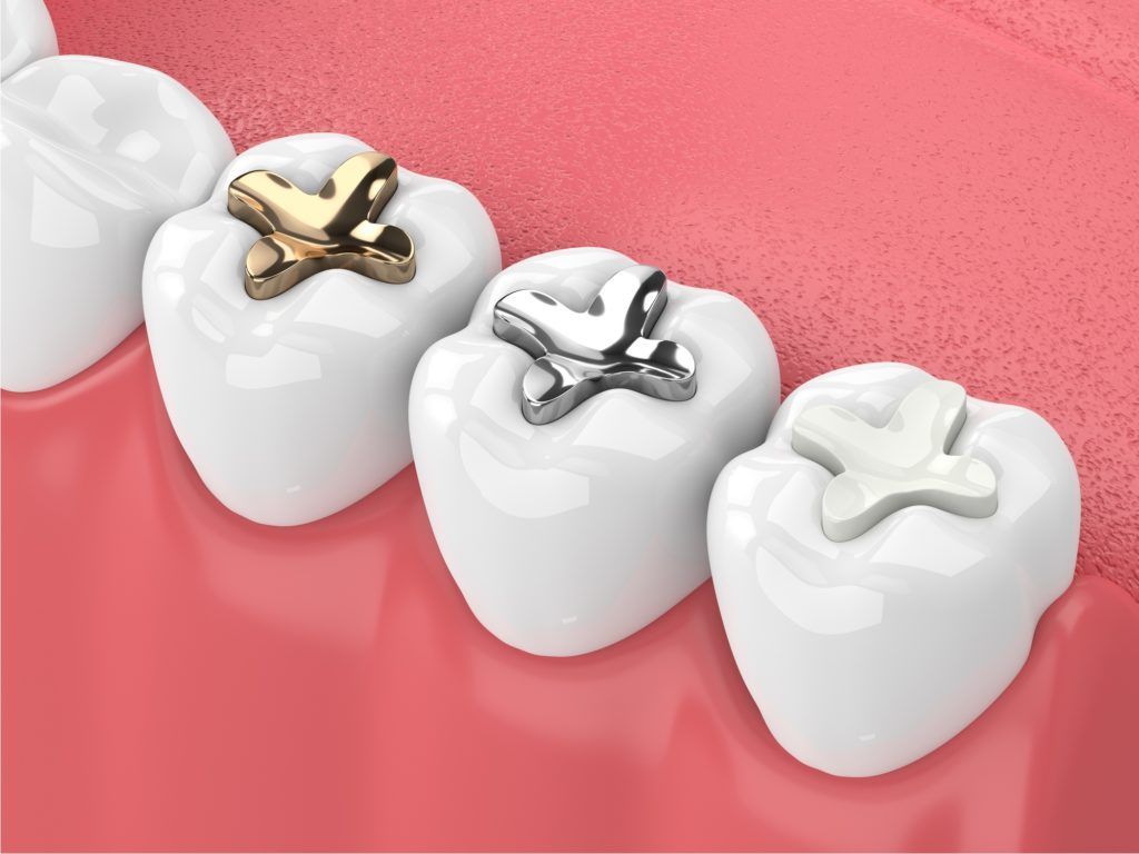 أنواع حشوات الأسنان