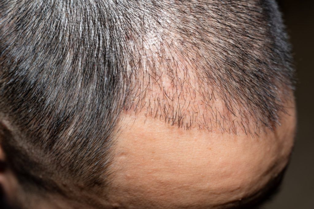 الآثار الجانبية المتوقعة بعد 3 شهور من زراعة الشعر