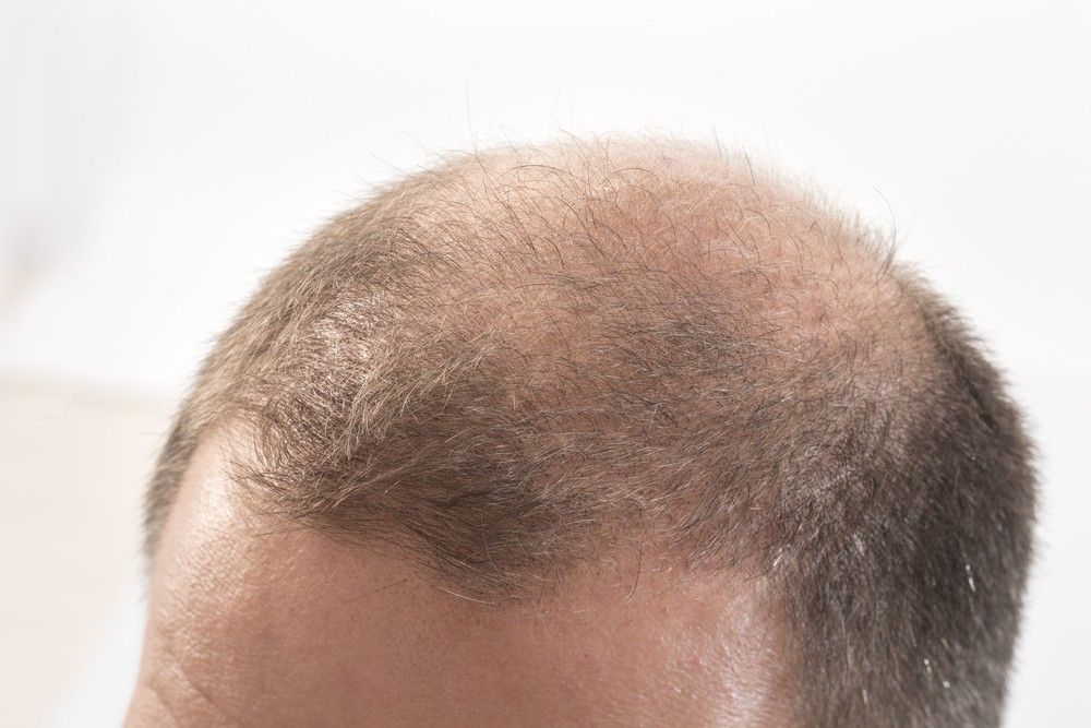 المرشحون لإجراء زرع الشعر بدون جراحة