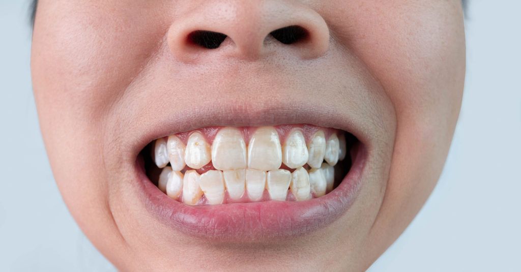 أعراض البقع البيضاء في الاسنان