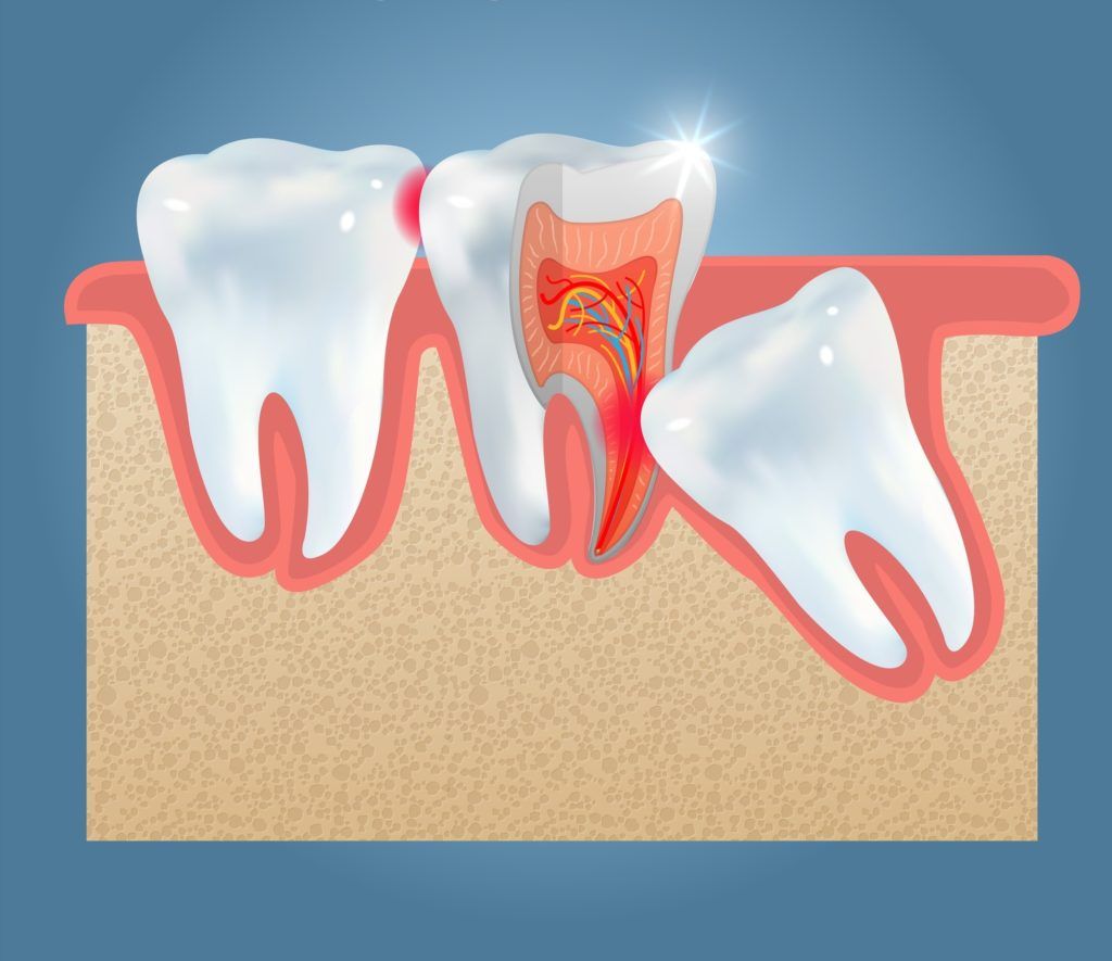علاج الأسنان المطمورة
