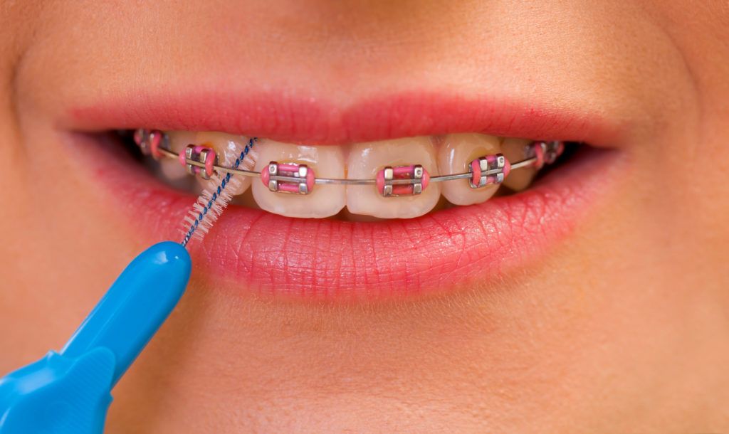 كيف يمكنك تفادي حدوث البقع البيضاء في الاسنان