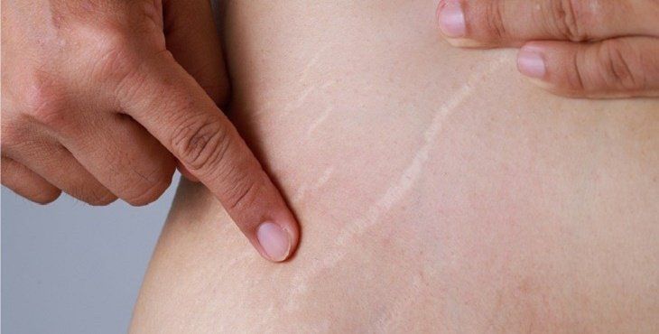ماهي علامات تمدد الجلد ؟