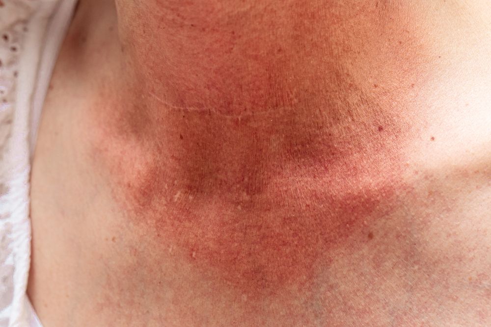  Dermatitis neglecta  التهاب الجلد المهمل