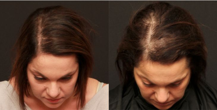  زراعة الشعر تجارب النساء