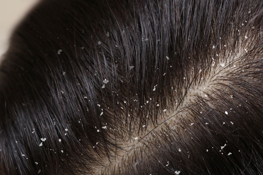 فوائد البيض في علاج قشرة الشعر