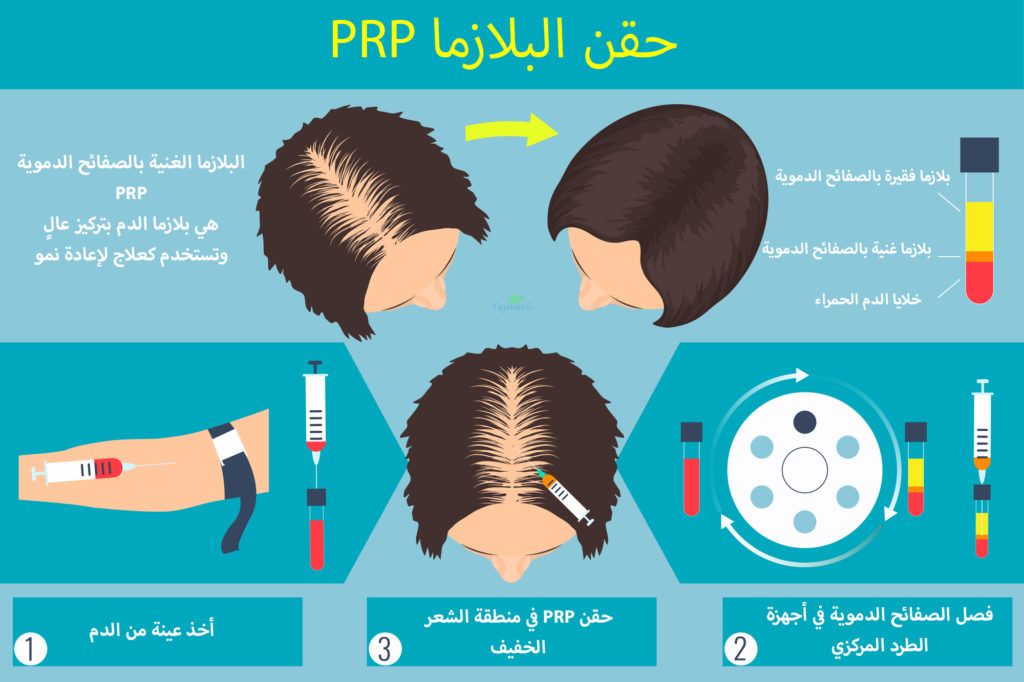 مدن في الأردن يمكن إجراء علاج الشعر بالبلازما فيها