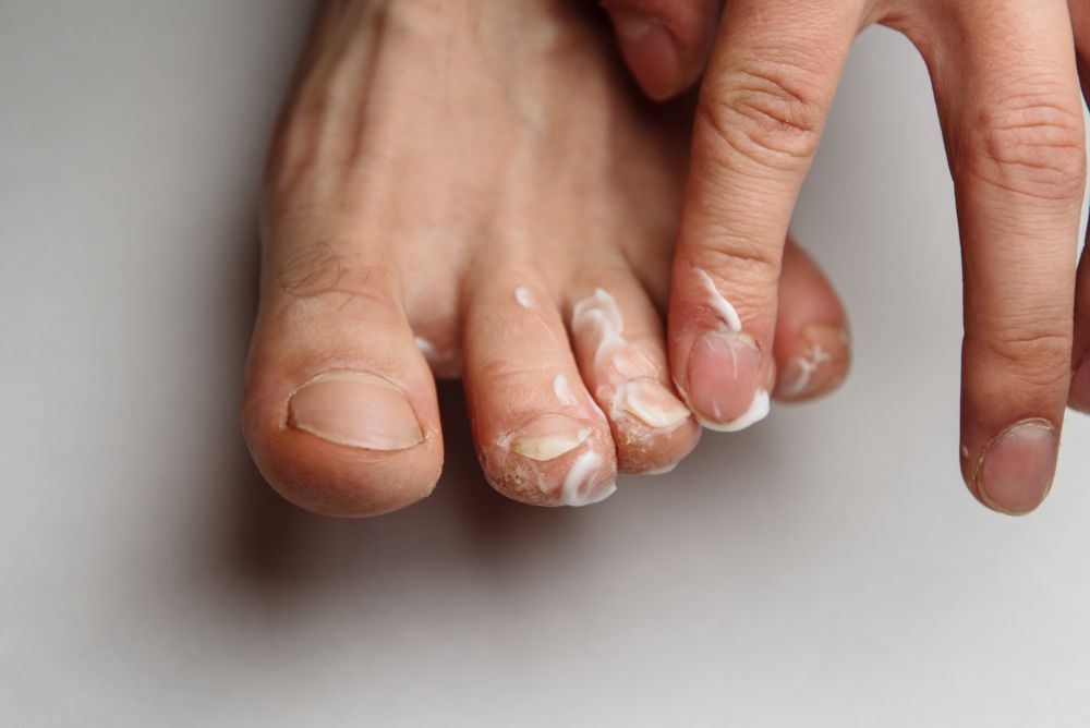 علاج تشقق الجلد حول الأظافر بالأدوية
