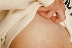 علاج تشققات البطن