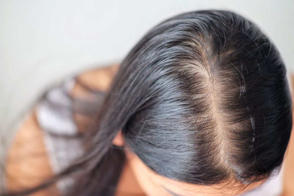 علاج فراغات الشعر الأمامية للنساء 