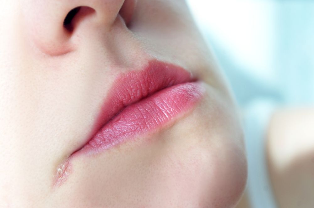 ما هو التهاب الشفة الزاوي وكيف يحدث تشقق زوايا الفم؟