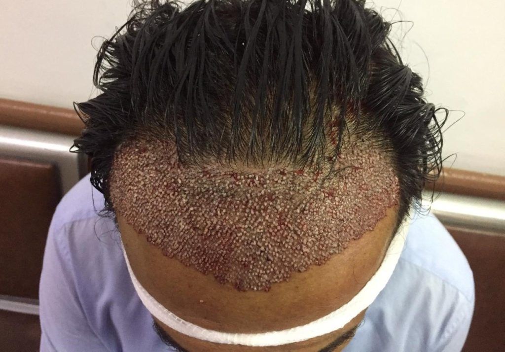ما هي عملية زراعة الشعر بدون حلاقة في مصر ؟