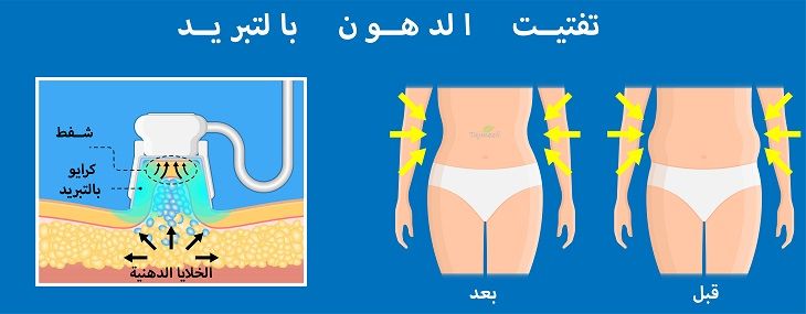 ما هي عملية شفط الدهون بالفيزر في الإمارات؟